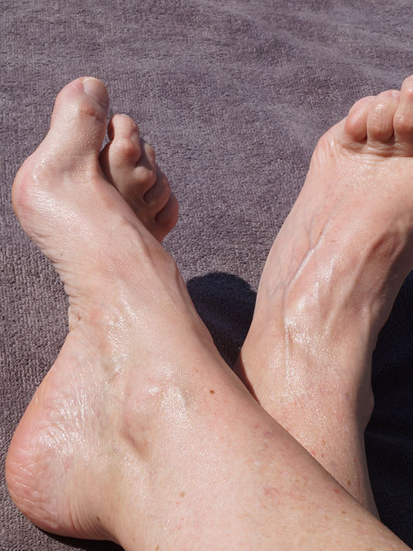 Deform feet with very high arch and hammertoes